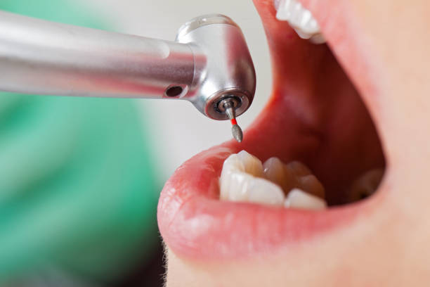 Best Emergency Treatment for Dental Infections or Abscesses in Blue Point, NY